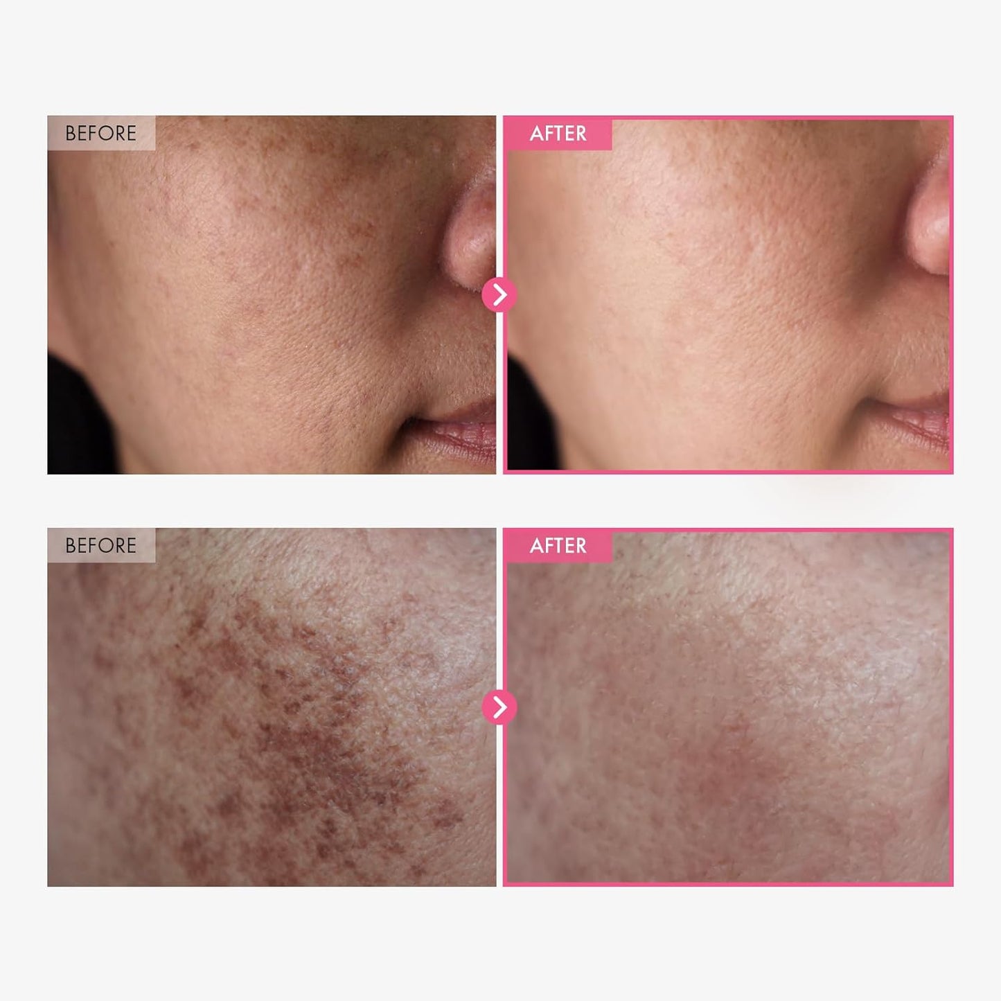 Arbutin 7.0 + TXA 4.0 Cream - Crema Despigmentante + Obsequio